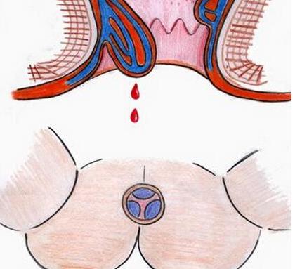 直肠指检百科,直肠指诊科普系列2