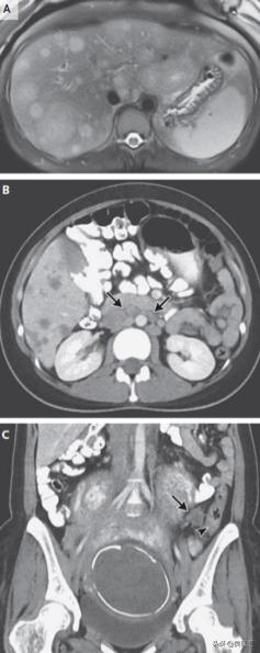 NEJM病例：36岁孕妇，诊断腺癌