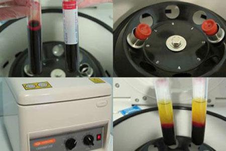 富血小板血浆治疗骨头坏死,林子洪医师