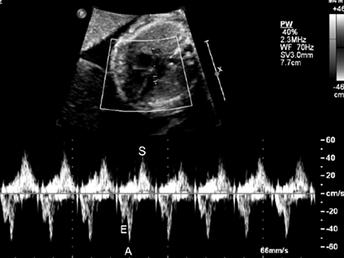 胎儿心电图心跳快是什么原因,胎儿心律不齐超声报告