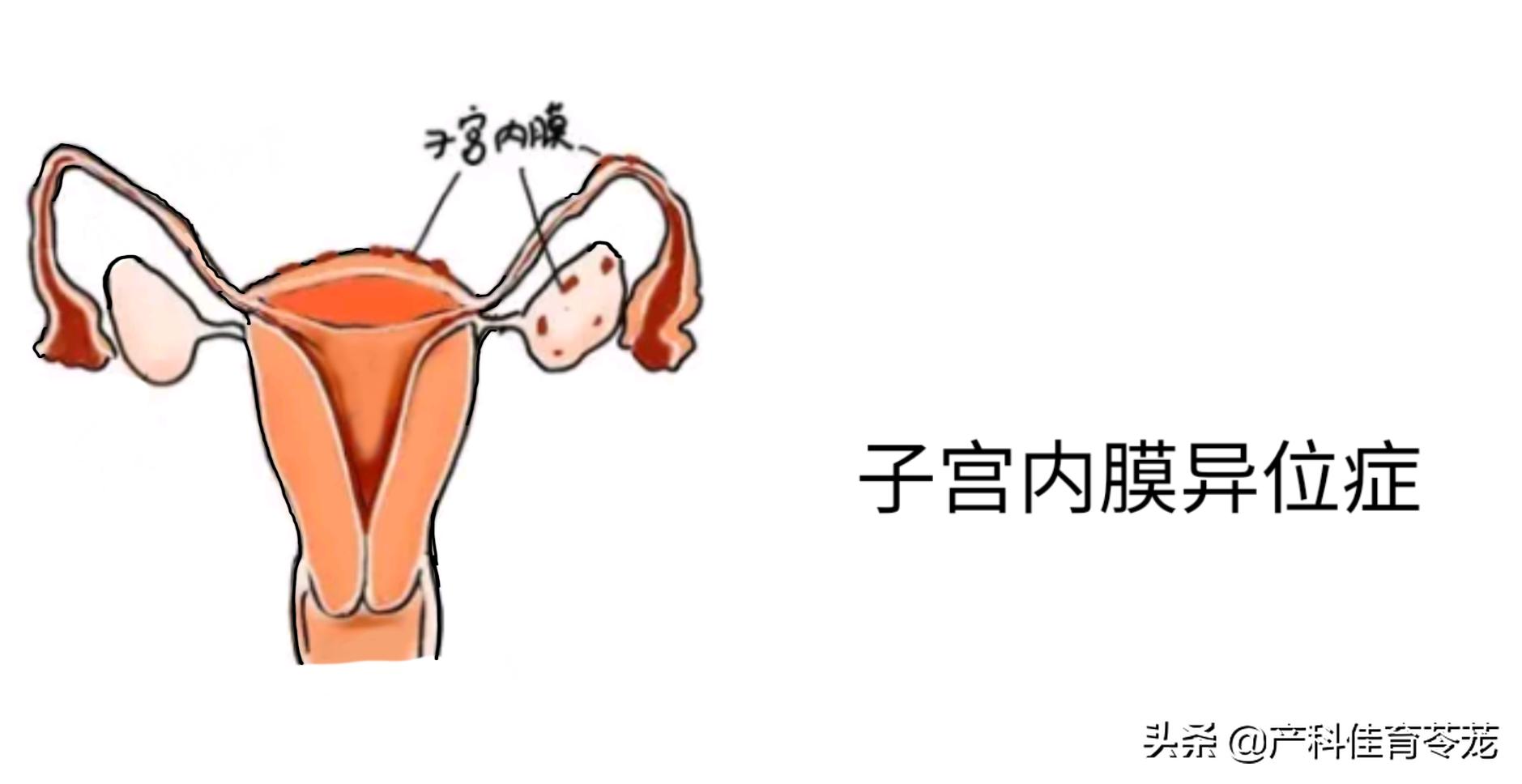 ca125正常到一个月急剧升高,ca125轻度升高与结直肠癌有关吗