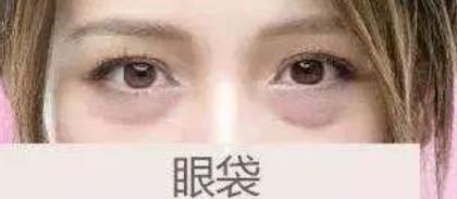 赵丽颖卧蚕眼袋,赵丽颖有眼袋与无眼袋