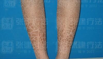 儿童鱼鳞病的症状表现,怎么区分寻常型与性连型鱼鳞病