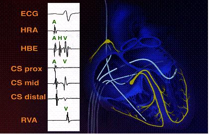 室早患者注意事项,室早严重会对身体有多大影响