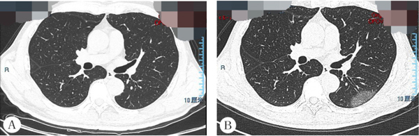 新型冠状病毒感染的肺炎，CT有何特点？和其他病毒性肺炎有何区别