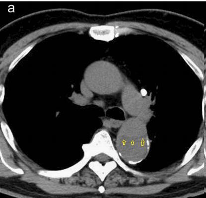 胸部Ct平扫能查出主动脉夹层吗,主动脉夹层cta影像图片解读