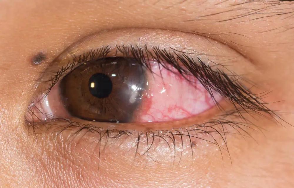 如何确定角膜塑形镜验配参数,角膜塑形镜验配最新规范