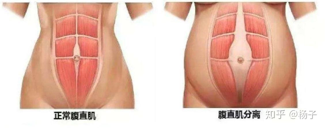 产后腰疼漏尿什么原因,产后腰疼会是腰间盘突出么