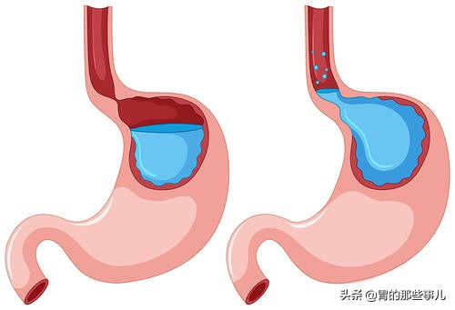 胃炎快速治疗的方法是什么,儿童慢性胃炎怎么治疗恢复得快