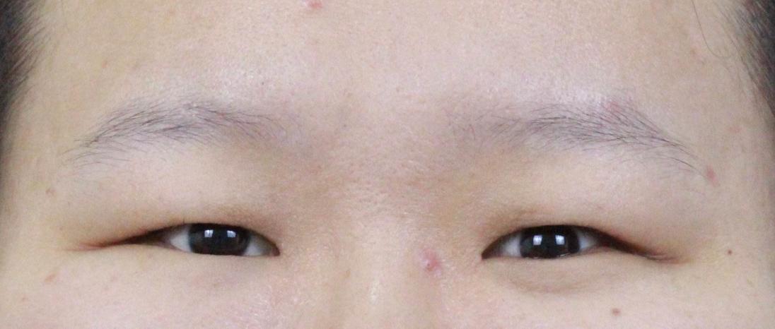割双眼皮要怎样才知道合适自己,割过双眼皮和没割过双眼皮的区别