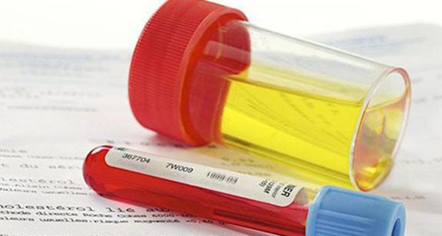 尿血是不是有病,肾病尿血危及生命吗