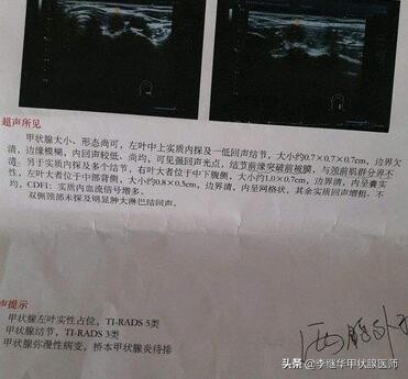 甲状腺结节良恶性鉴别方法,甲状腺结节恶性5类严重吗