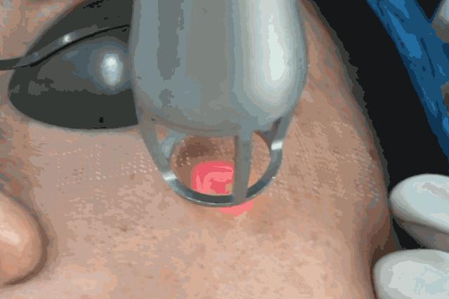 毛孔已经很大了,毛孔越来越大还长痘