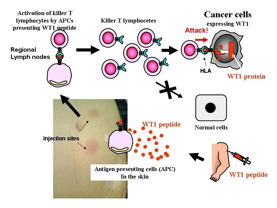 为什么免疫治疗后肿瘤不缩小,为什么免疫治疗不适合胃癌