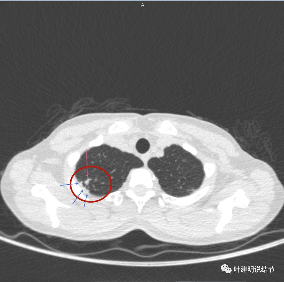 临床诊断孤立性肺结节,空洞型结节一般是什么性质