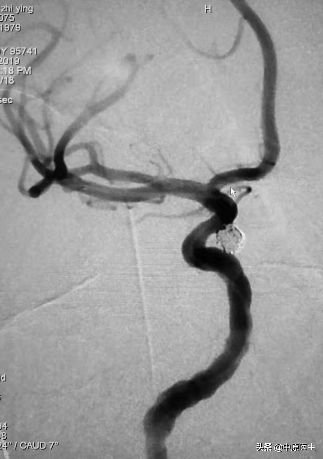 大脑双侧动脉瘤,发现脑内有两个瘤医生说不管