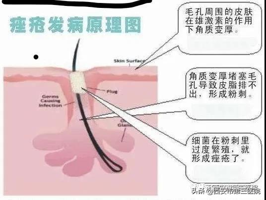 脸上全是痘真正有效的办法,脸上长小痘痘不疼不痒是什么痘