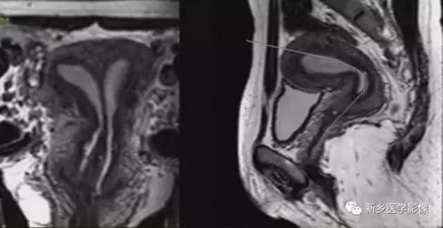 子宫发育异常,应想到的6大类常见畸形