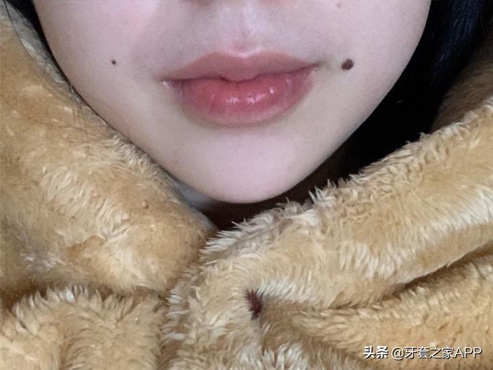 不靠整容怎么改变下巴后缩?看这里