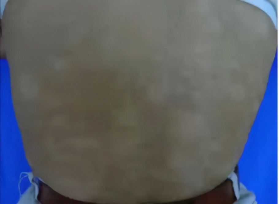 白斑是白癜风还是糠疹如何鉴别呢,宝宝脸上有白斑是脾胃虚吗