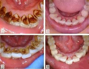 牙齿上出现了黑线怎么办,牙齿上都有黑线怎么办