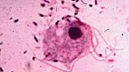 女性阴道炎怎么办？做好这些事，远离难“炎”之隐