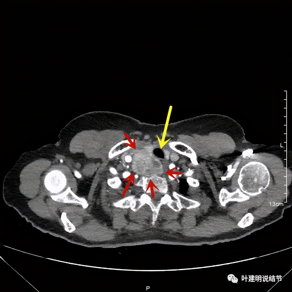 胸部高分辨ct检查注意事项,胸部ct扫描有没有危害