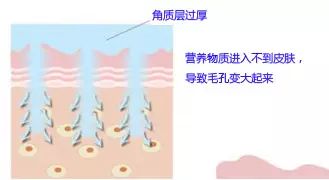 毛孔也分三六九等,你属于哪一茬?