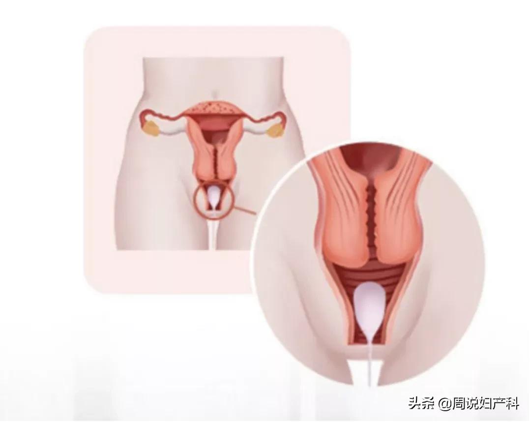 生完孩子后憋不住尿,生完孩子憋不住尿怎么办