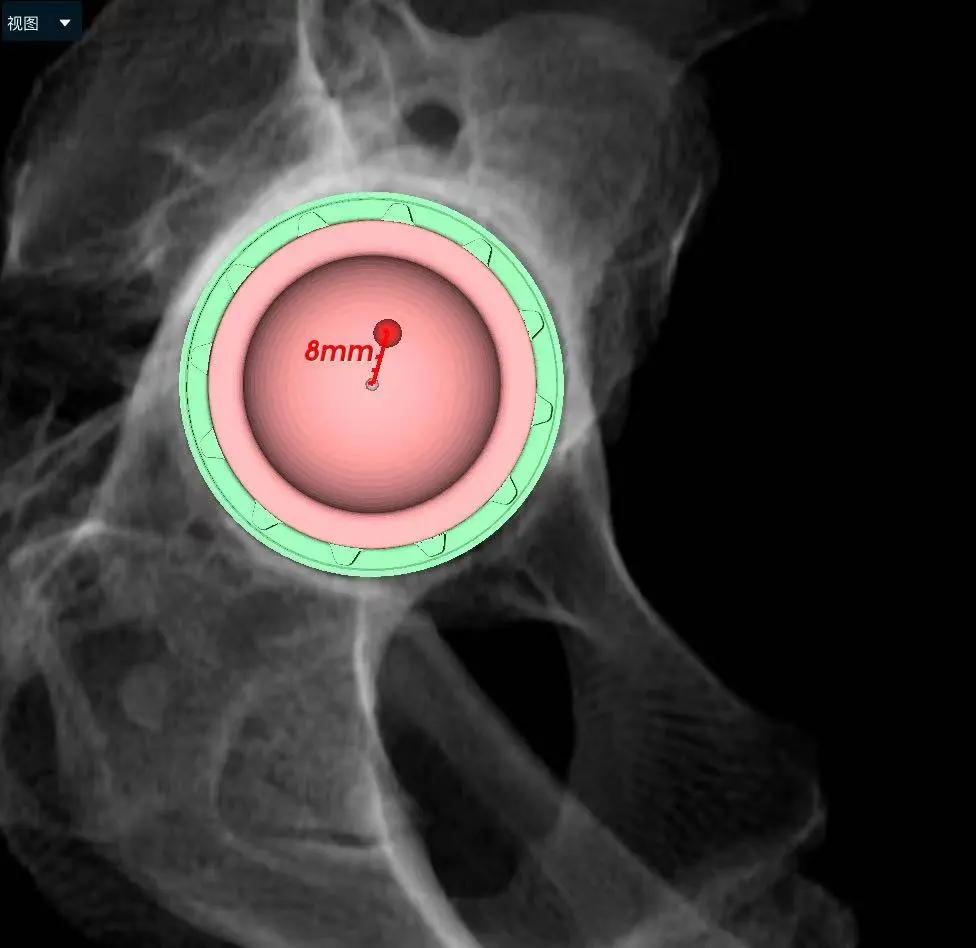 间歇性跛行一年了一直能走五百米,间歇性跛行一年了能恢复吗