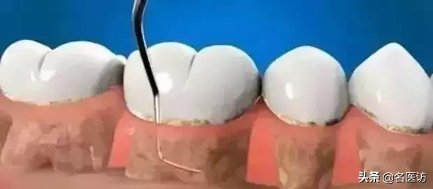 洗牙和牙周刮治区别在哪里,洗牙刚洗好隔天能做牙周刮治吗