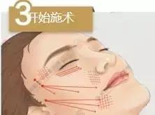 线雕一般多久做一次比较好,线雕多做几次维持的时间会越长吗