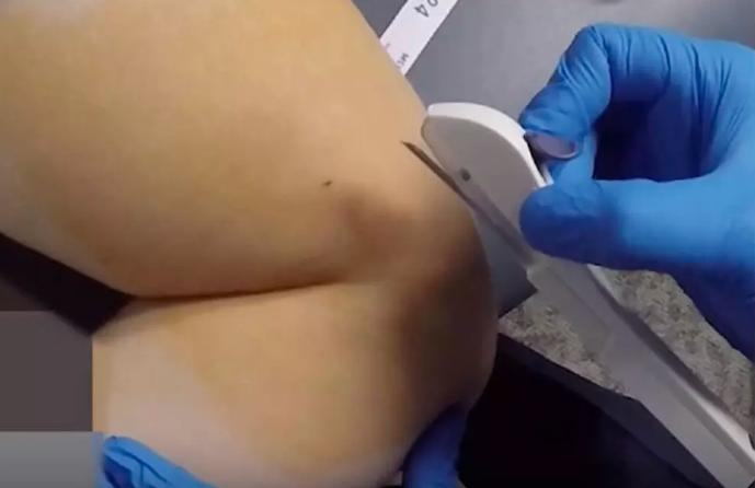 小两口因皮下避孕大动干戈,少妇用亲身经历告诉你啥是皮下避孕