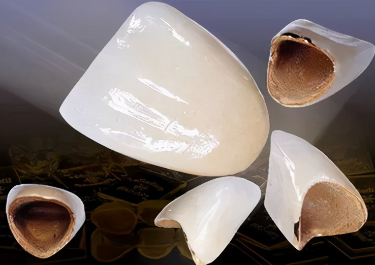 烤瓷牙基底冠如何清洁不崩瓷,烤瓷牙咬合面崩瓷必须重做吗