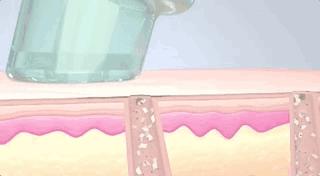 自发泡清洁黑头粉刺小气泡面膜,小气泡去黑头粉刺清洁神器好不好