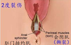 顺产什么情况会被侧切,顺产时候啥情况会引起大出血
