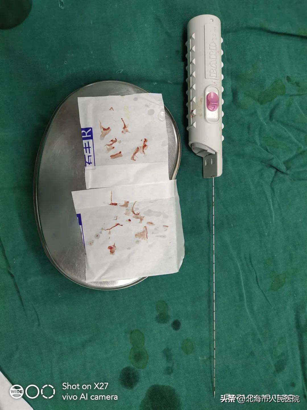 提高手术难度，降低感染风险——我院泌尿外科开展局麻下经会阴部超声引导下前列腺穿刺活检术