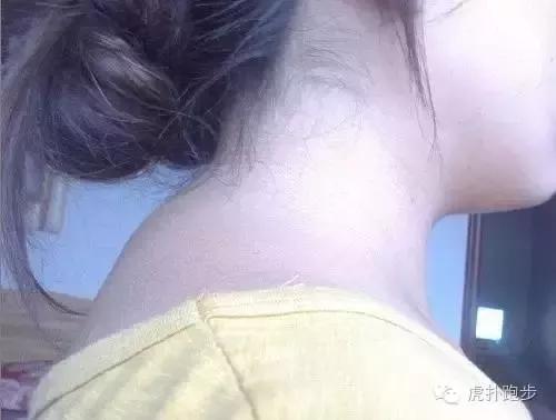 脖子后面鼓个小包怎么回事,颈椎病后面脖子有硬块