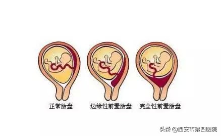 剖宫产的孩子和顺产的孩子的区别,一胎剖宫产二胎顺产的几率有多大