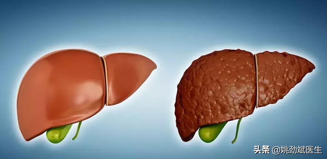 痔疮是肝硬化引起的吗,肝硬化痔疮出血