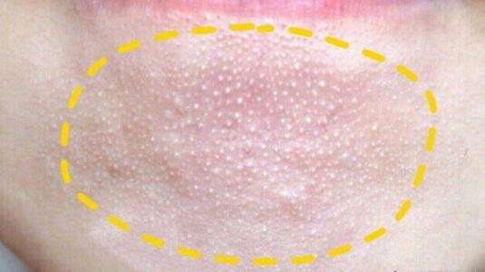 怎么去掉脸上的小米粒视频,脸上都是小米粒疙瘩怎么去掉