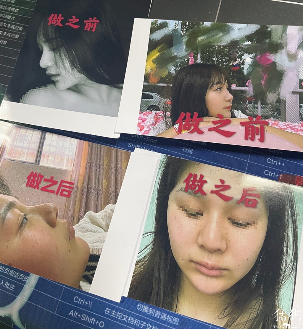 周口24岁女子花1.2万整鼻子,不料鼻子越来越大还发臭