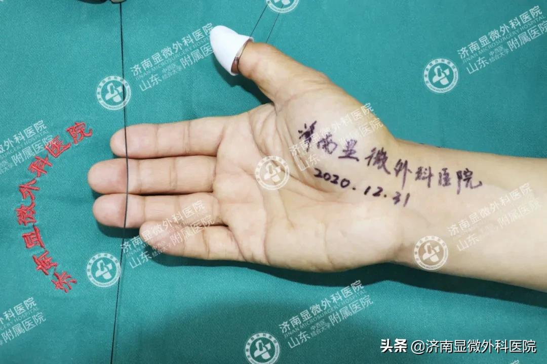 手指少了一块肉怎么处理,手指少了一截