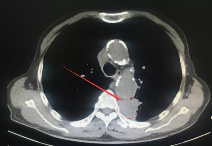 胃痛是肺癌胃疼吗,胃痛是肺癌的前兆