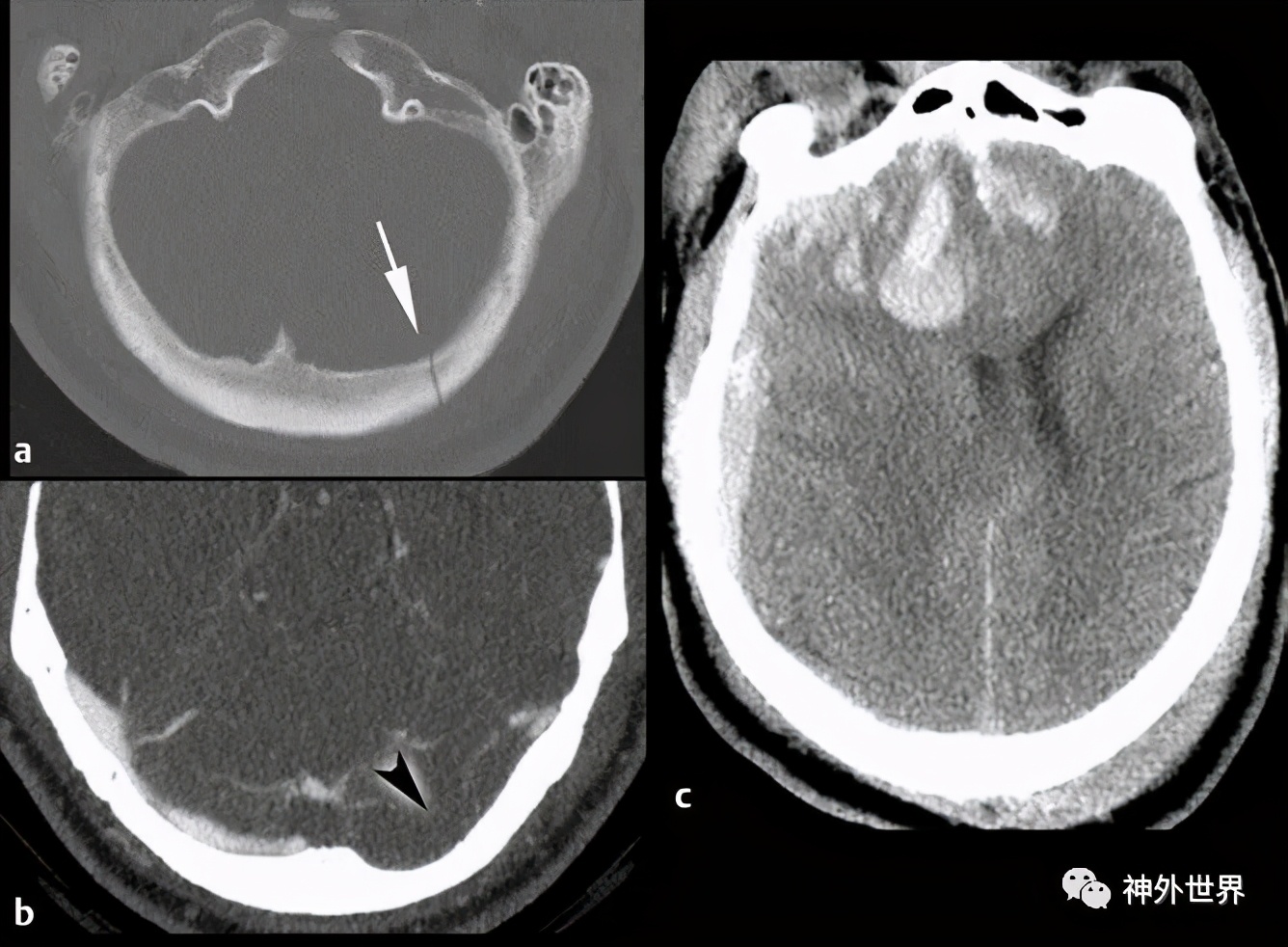 颅底骨折合并脑脊液漏伤情鉴定,颅底骨折伴脑脊液漏右眼眶骨折