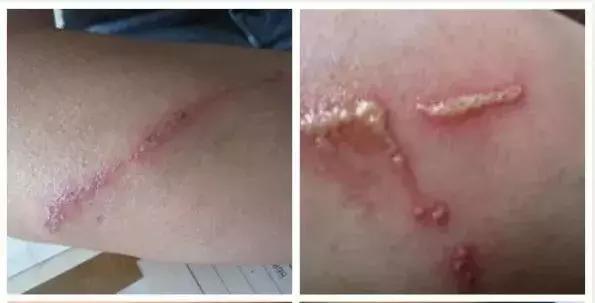 宝宝被蚊虫咬了之后该怎么处理,夏季蚊虫比较多如何避免宝宝被咬