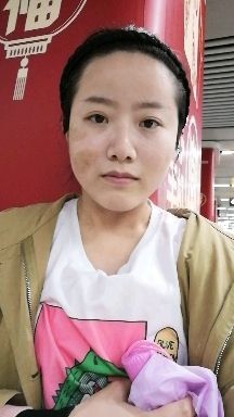 陈金西细胞种植可靠吗,陈金西细胞再生技术疤痕修复