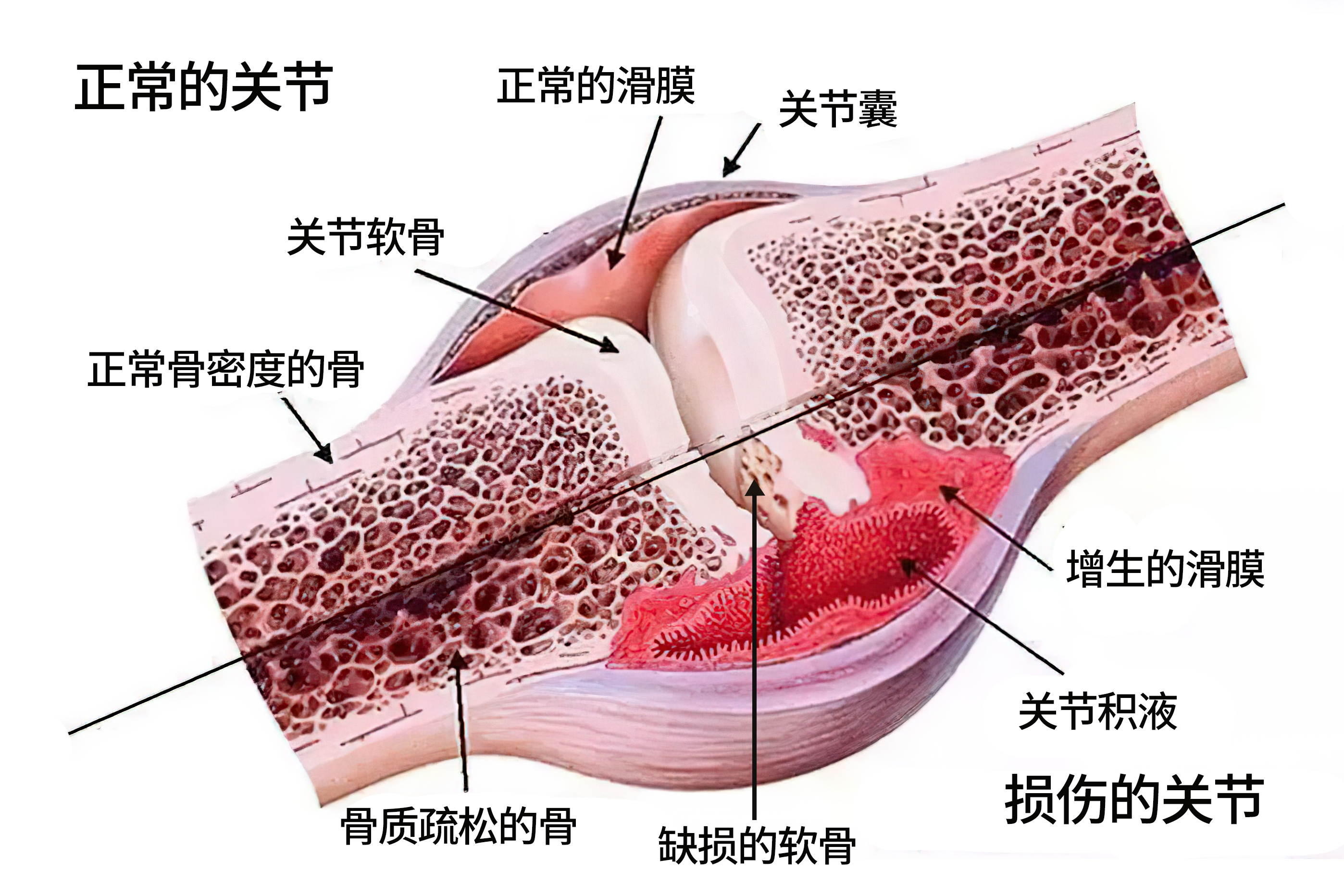 关节炎非甾体类消炎止痛药,非甾体类抗炎止痛药的禁忌