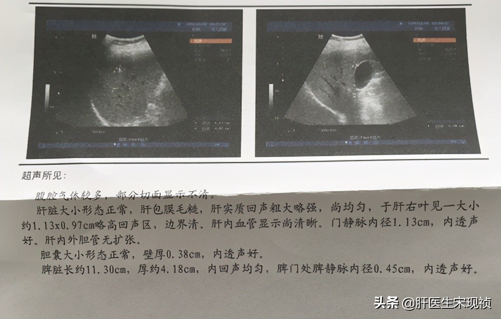 乙肝患者转氨酶正常用不用治疗,转氨酶不高有乙肝可以吃护肝药吗