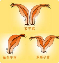 孕育宝宝会遇到哪些困难,子宫畸形的六种情况